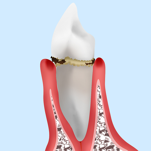 軽度歯周炎（歯肉炎）
