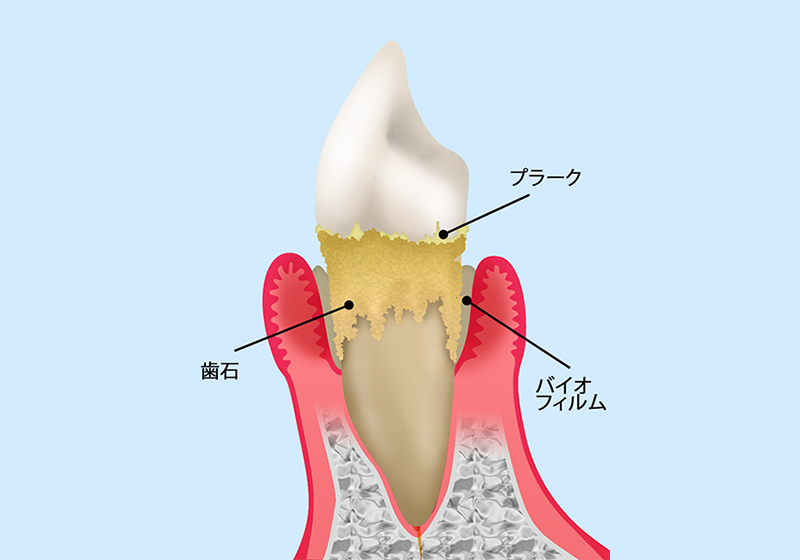 知っておきたい「嫌気性歯石プラーク」