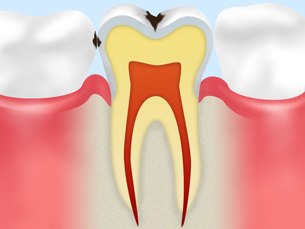 C1(エナメル質の虫歯)