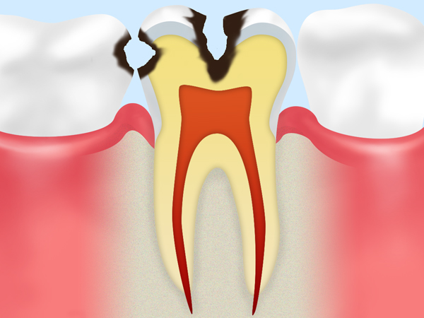 C2(象牙質の虫歯)