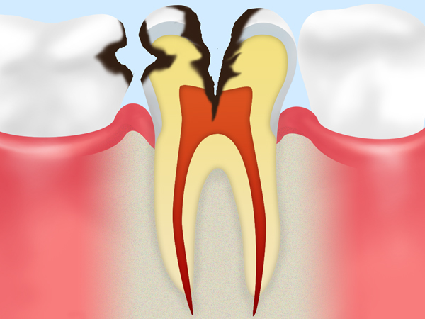 C3(神経まで達した虫歯)